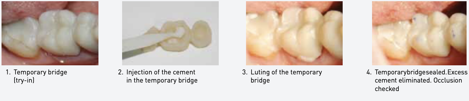 Xi măng gắn tạm có nền nhựa Seal Temp S Elsodent Pháp